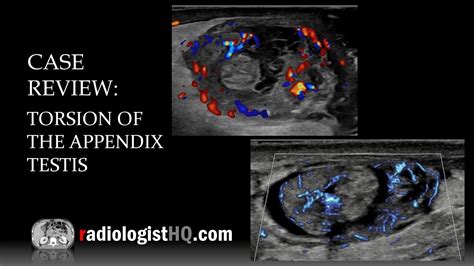 Torsion of the Appendix Testis and Appendix Epididymis